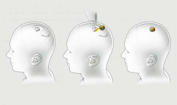 Neurolink: Ο Μασκ δοκιμάζει σε ανθρώπους τα «τσιπ εγκεφάλου»