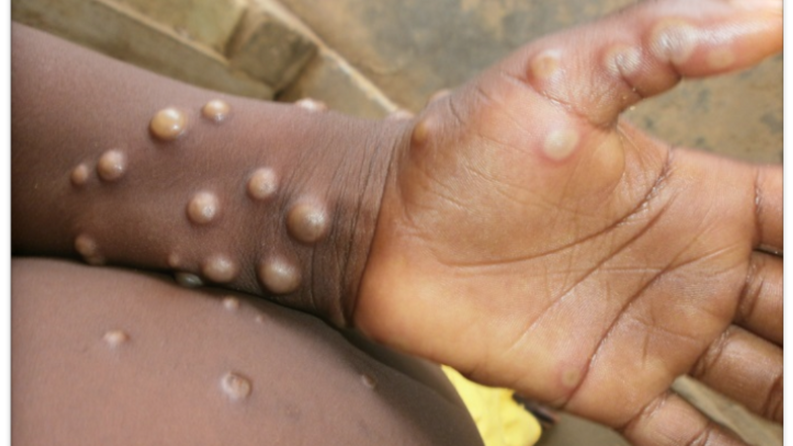 A suspected case of monkeypox examined in Greece