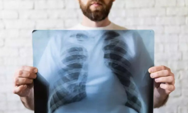 Kαρκίνος πνεύμονα: Αναγκαίος ο προληπτικός έλεγχος για καλύτερη θεραπεία