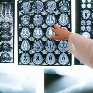 Τεχνητή νοημοσύνη με ελληνική συμμετοχή τα βάζει με θανατηφόρο καρκίνο του εγκεφάλου